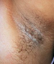 Acanthosis